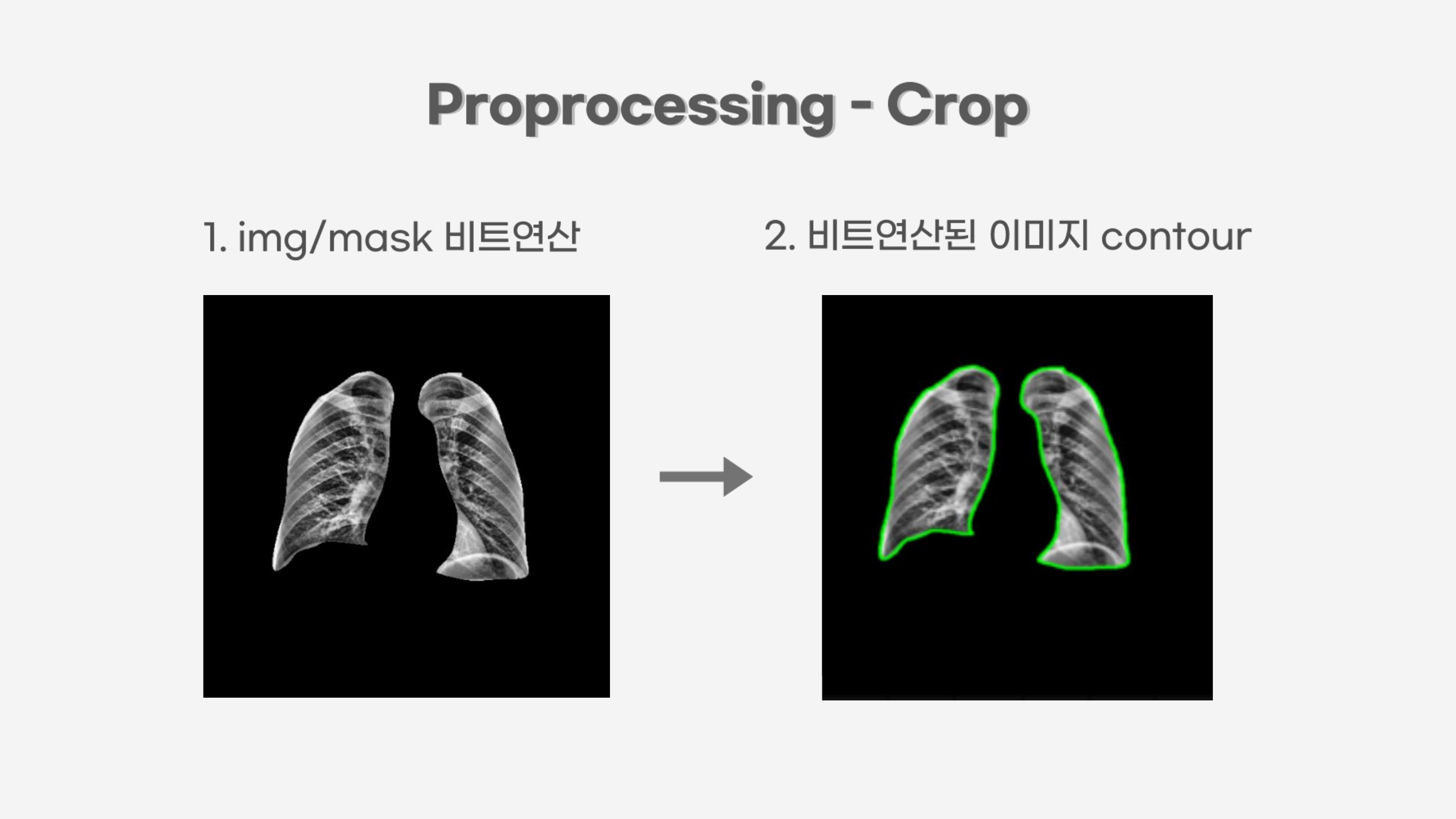 소아 흉부 엑스레이에서 폐 영역을 분리하는 AI 전처리 화면
